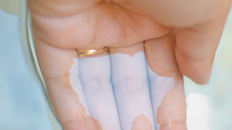Photo The Future of Wearable Patches for Continuous Glucose Monitoring