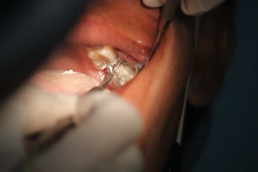 Photo Smart Implant