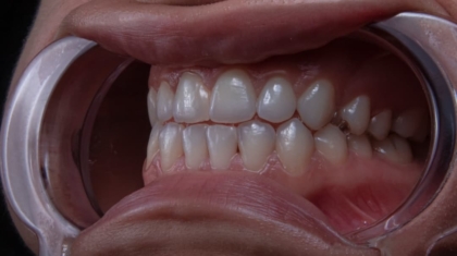 Photo Mouthguards